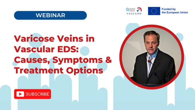 Varicose Veins in vEDS Explained