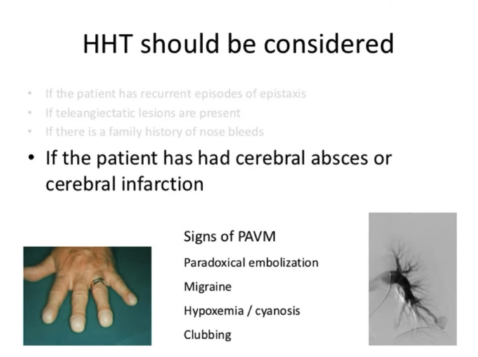 What ENT doctors should know about HHT
